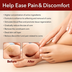 Feet Corn Removal Serum 30ml ( Pack Of 1 )